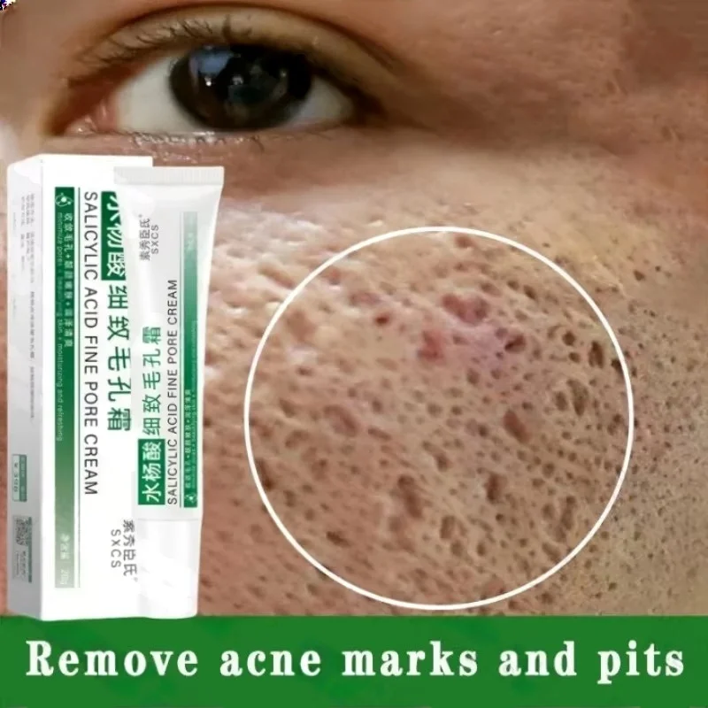 Salicylic Acid Blackhead Remover - Salicylic Acid Pore Clearing Cream รูขุมขนหดตัวลบสิวหัวดําสิว